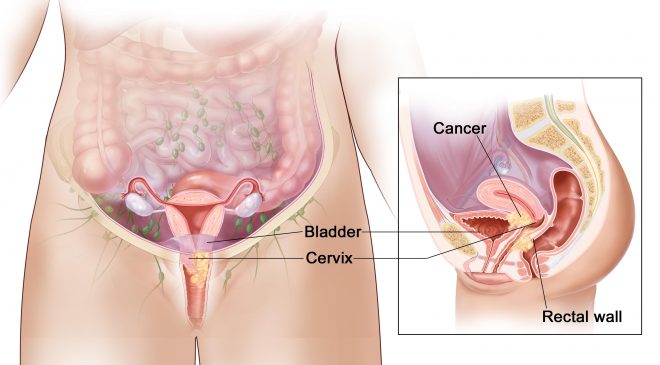 Avoid multiple sexual partners to prevent cervical cancer