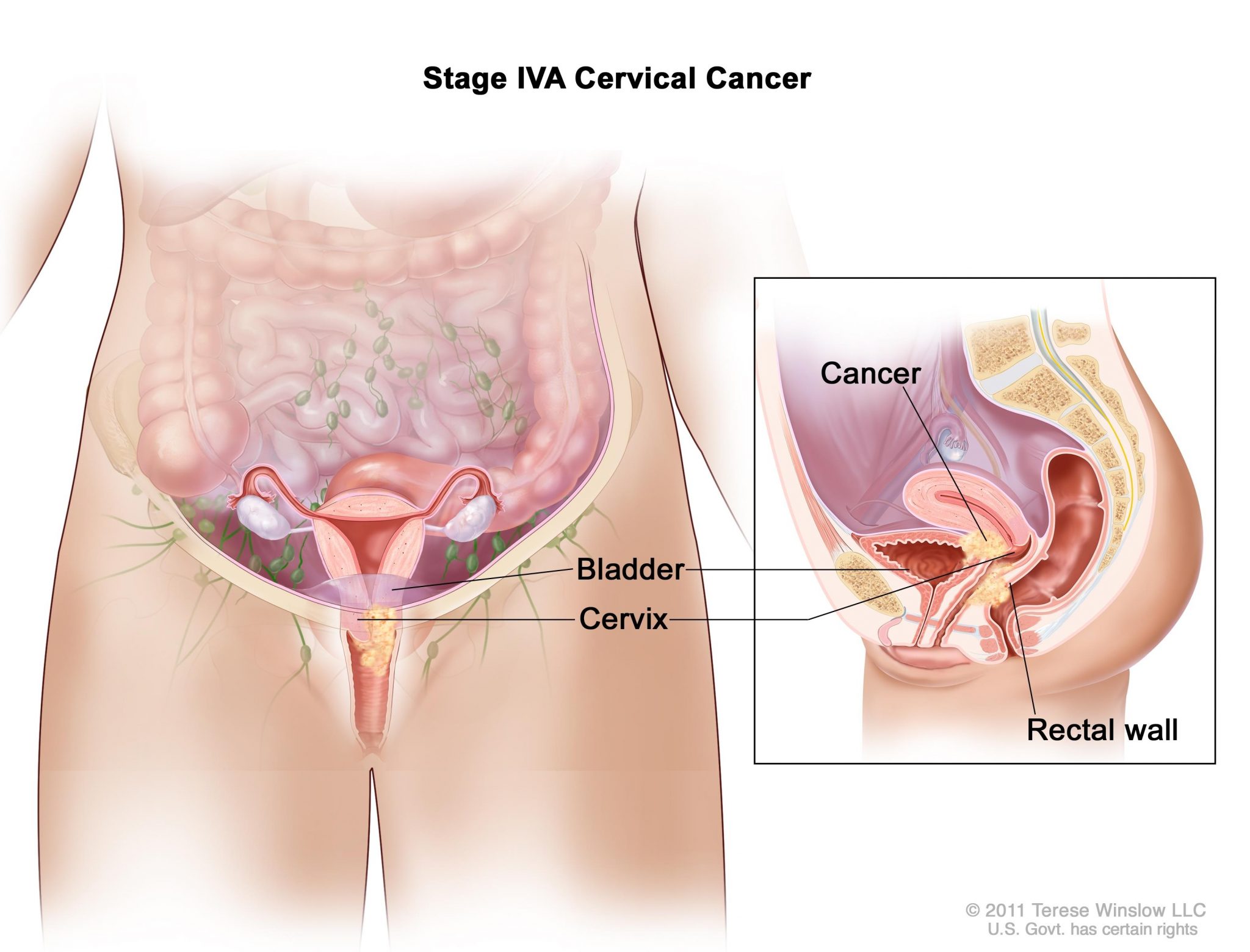 Avoid multiple sexual partners to prevent cervical cancer