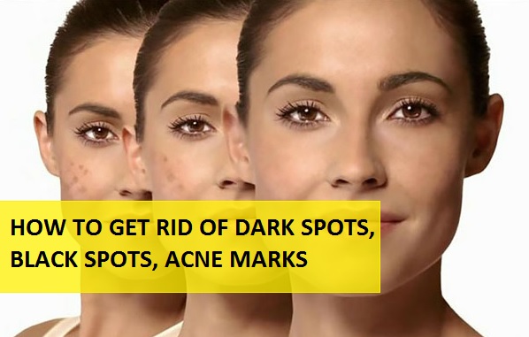 Acne Facts Your Dermatologist Isn’t Telling You